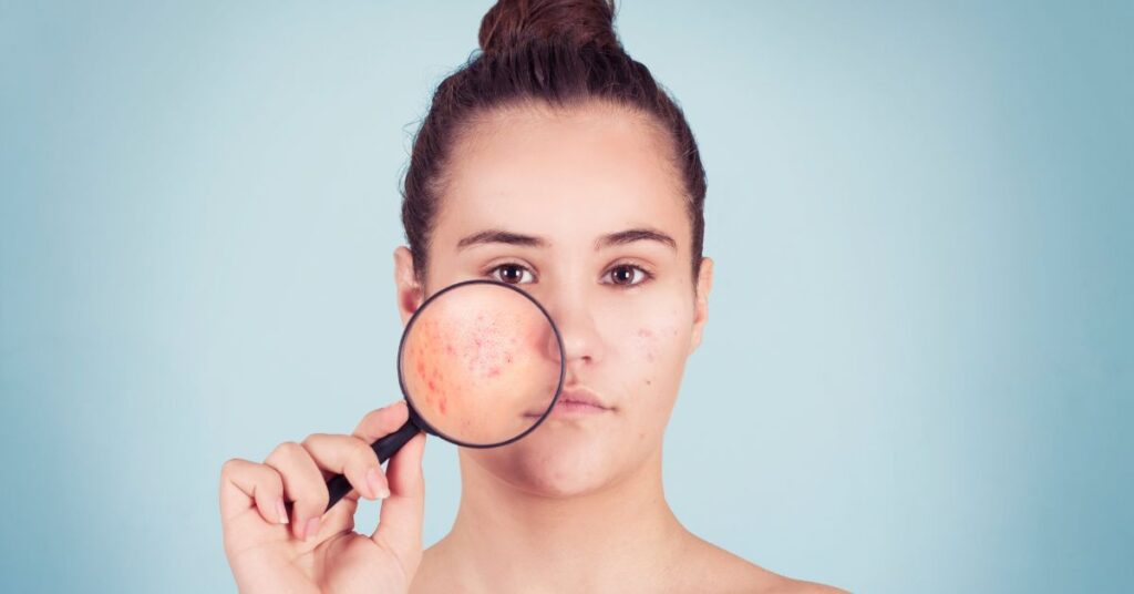 Chlorophyll For Skin Whitening: Secret To Brighter & Clear Skin 3 chlorophyll reduce acne