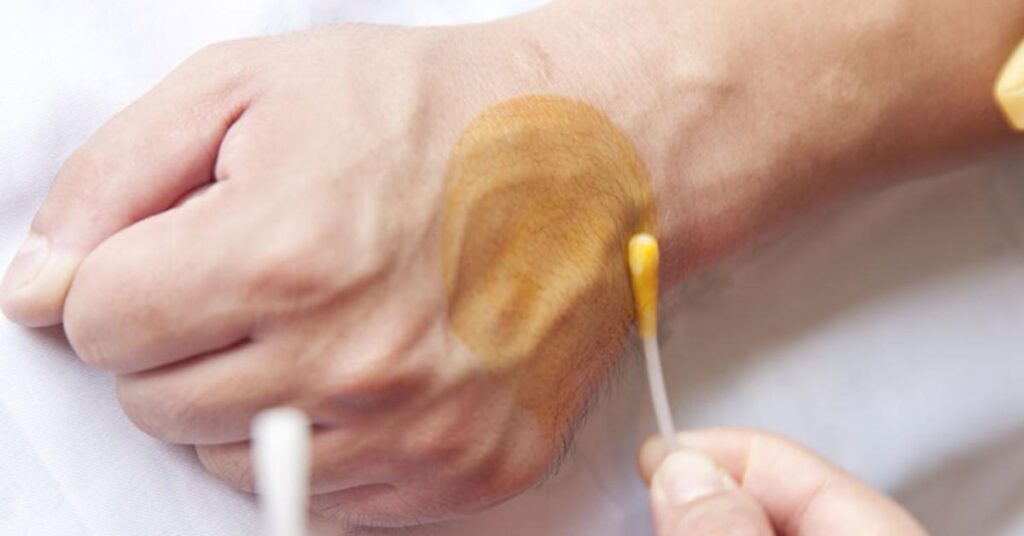 How To Perform The Iodine Patch Test? 1 How To Perform The Iodine Patch Test